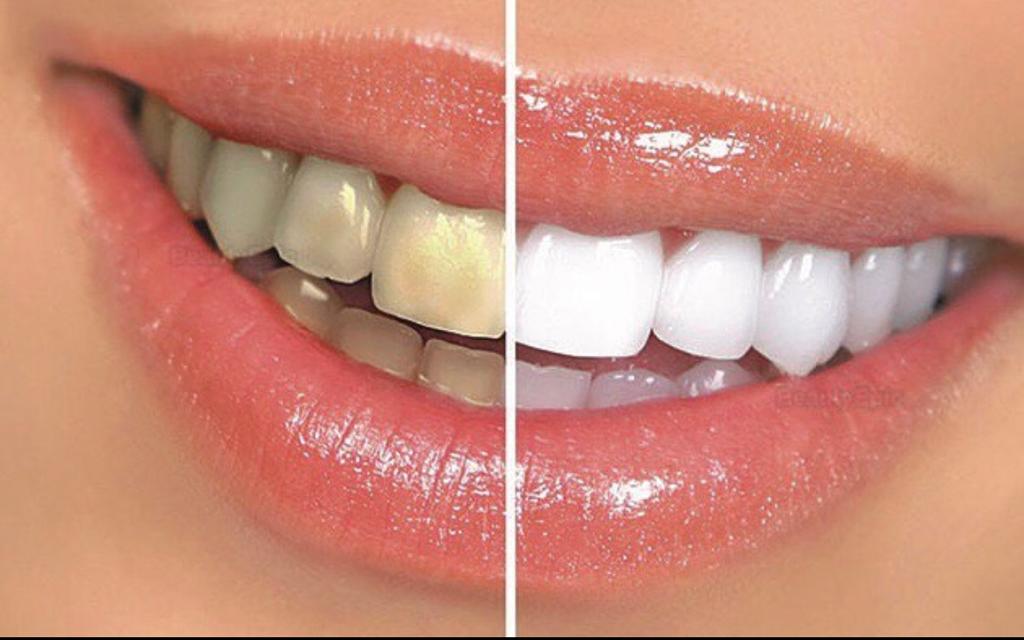 de top vijf redenen waarom u uw tanden moet bleken